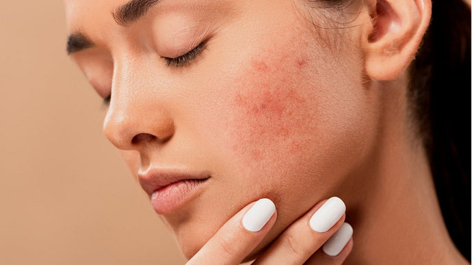 Home remedies and diet tips for acne